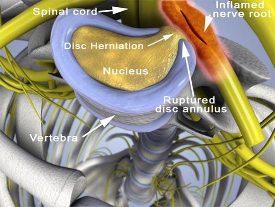 Herniated Disc