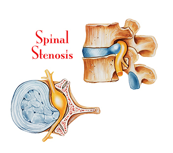 Spinal Stenosis